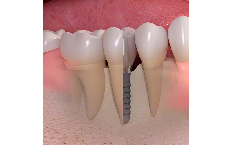インプラントイメージ